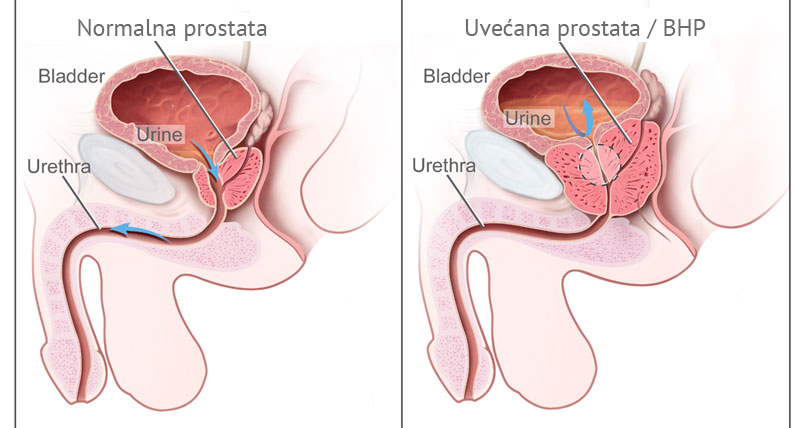 prostatitis a férfiakon a műtét után)