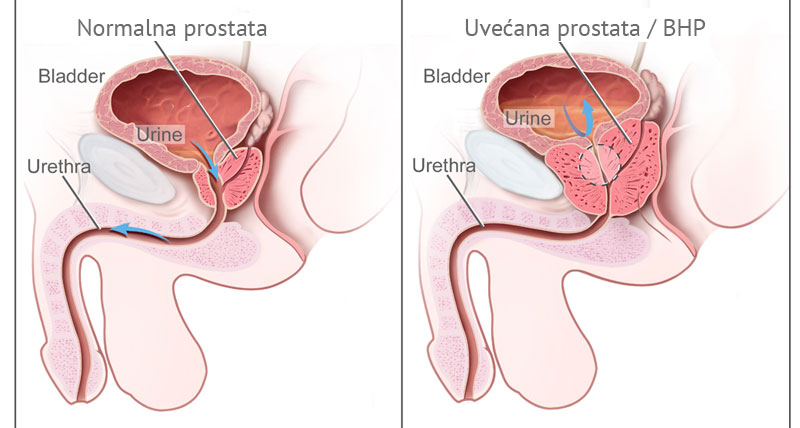 Uvećana prostata